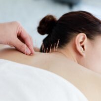 Intake & Acupuncture Treatment